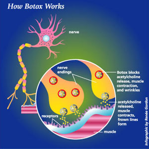 botox | how botox works | dr alek nikolic