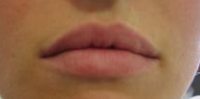 one week after treatment