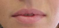 Before treatment