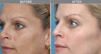 Skin Photo-Rejuvination | Dr Alek Nikolic