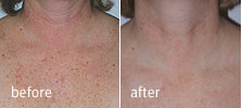 Skin Photo-Rejuvination | Dr Alek Nikolic