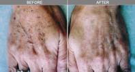Skin Photo-Rejuvination | Dr Alek Nikolic