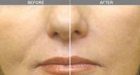 Skin Tightening & Lifting | Dr Alek Nikolic