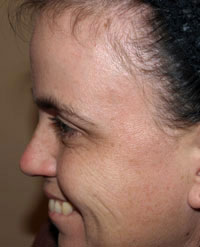 Botox Treatment: After | Crow&rsquo;s Feet