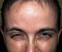 Botox Treatment: After | Glabella (Frown Area)