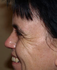 Botox Treatment: Before | Crow&rsquo;s Feet