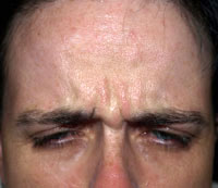 Botox Treatment: Before and After | Glabella (Frown Area)