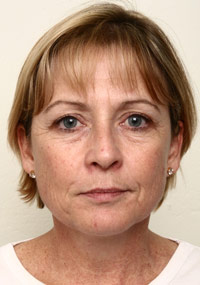Combination Treatments Before